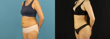 Brazilian Butt Lift case #5169