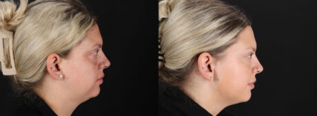 Filler case #256472