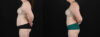 Tummy Tuck case #256538 slider thumbnail