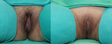Labiaplasty case #256546