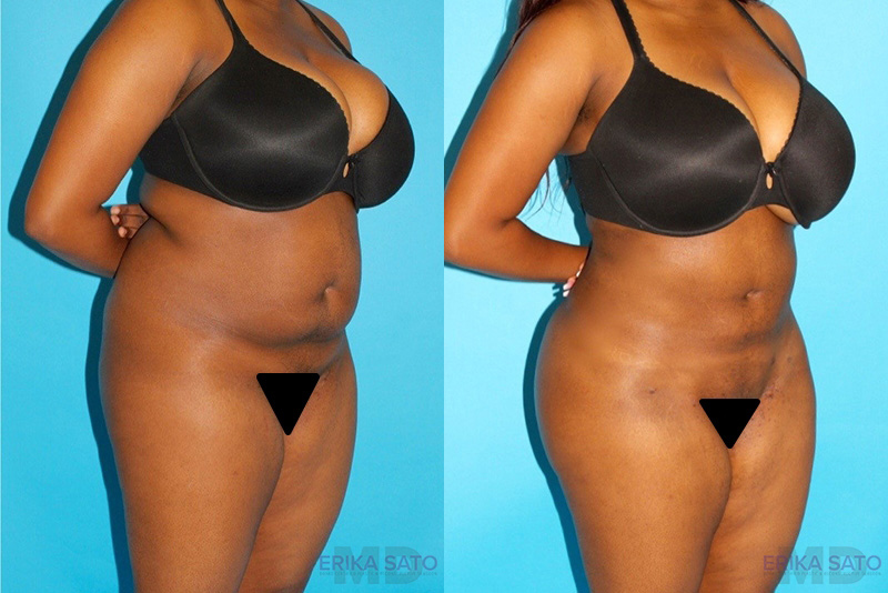 Brazilian Butt Lift case #256576