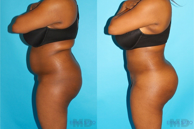 Brazilian Butt Lift case #256576