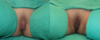 Labiaplasty case #256820 slider thumbnail