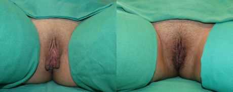Labiaplasty case #256820