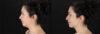 Submental Liposuction case #257416 slider thumbnail