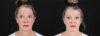 Botox® & Other Neuromodulators case #257429 slider thumbnail