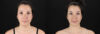 Submental Liposuction case #257416 slider thumbnail