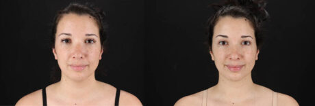 Submental Liposuction case #257416