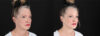 Botox® & Other Neuromodulators case #257429 slider thumbnail