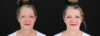 Botox® & Other Neuromodulators case #257429 slider thumbnail
