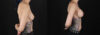 Breast Augmentation case #6444 slider thumbnail