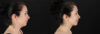 Submental Liposuction case #257416 slider thumbnail