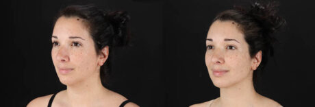 Submental Liposuction case #257416
