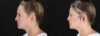 Botox® & Other Neuromodulators case #257429 slider thumbnail