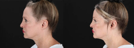 Botox® & Other Neuromodulators case #257429