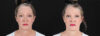 Botox® & Other Neuromodulators case #257429 slider thumbnail