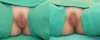 Labiaplasty case #257468 slider thumbnail