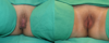 Labiaplasty case #258770 slider thumbnail