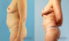 Fat Grafting to the Breast case #261036 slider thumbnail