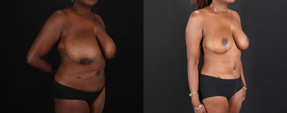 Mommy Makeover case #261346