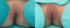 Labiaplasty case #262971 slider thumbnail