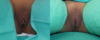 Labiaplasty case #262880 slider thumbnail