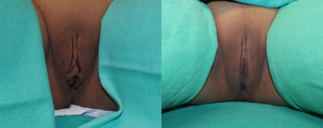 Labiaplasty case #262880