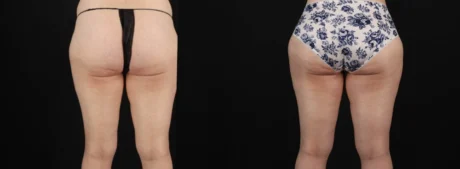 Tummy Tuck case #263466
