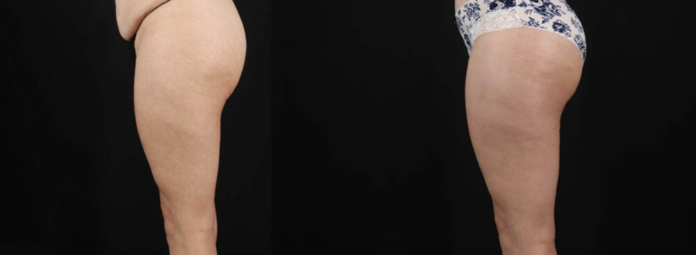Tummy Tuck case #263466
