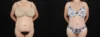 Tummy Tuck case #263466 slider thumbnail