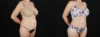 Tummy Tuck case #263466 slider thumbnail