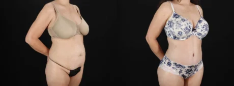Tummy Tuck case #263466