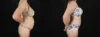 Tummy Tuck case #263466 slider thumbnail