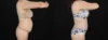 Tummy Tuck case #263466 slider thumbnail
