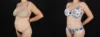 Tummy Tuck case #263466 slider thumbnail
