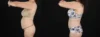 Tummy Tuck case #263466 slider thumbnail