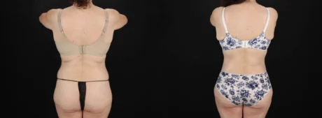 Tummy Tuck case #263466