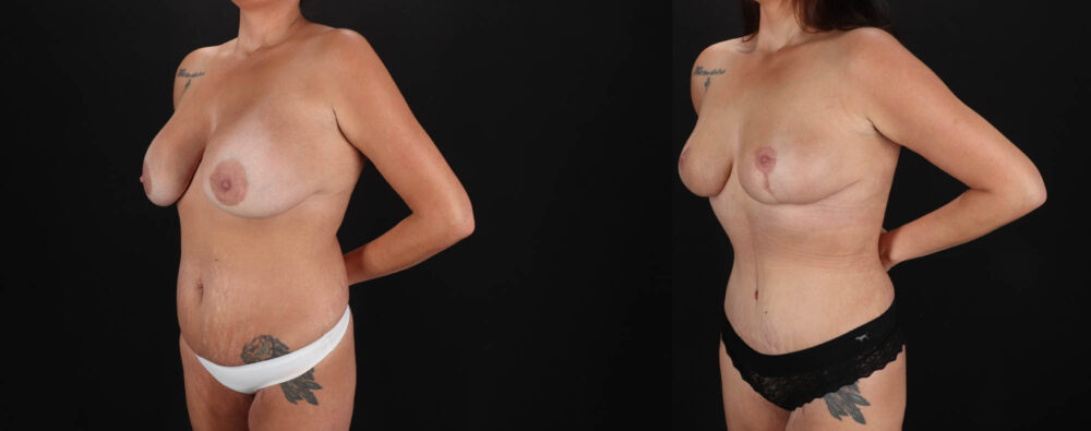 Mommy Makeover case #263966