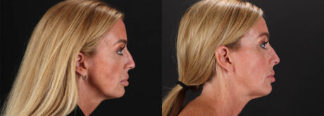 Filler case #263983