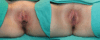Labiaplasty case #263446 slider thumbnail