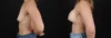 Breast Augmentation case #264418 slider thumbnail