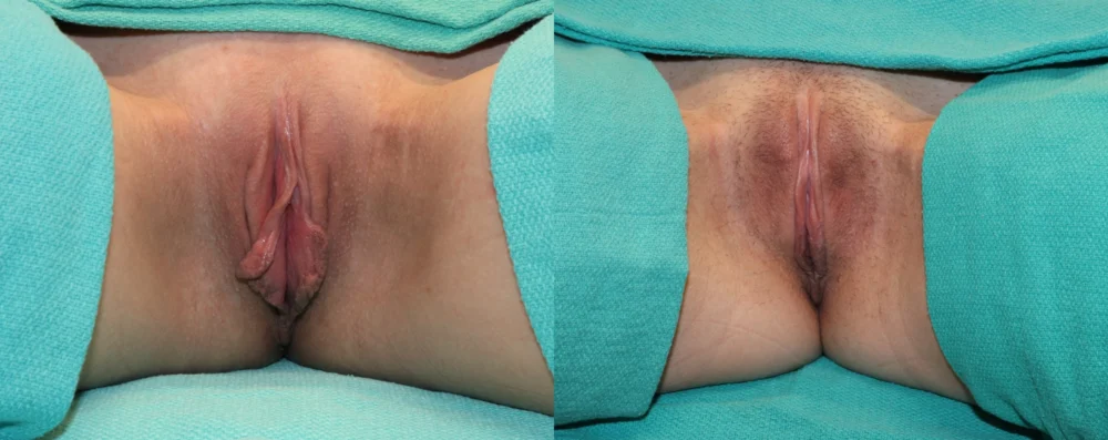 Labiaplasty case #264416