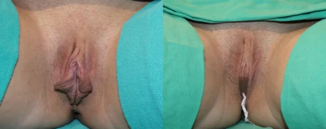 Labiaplasty case #264399