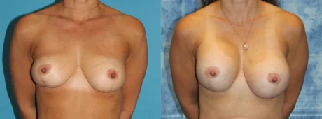 Fat Grafting to the Breast case #264627
