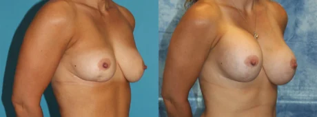 Fat Grafting to the Breast case #264627