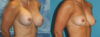Fat Grafting to the Breast case #264627 slider thumbnail