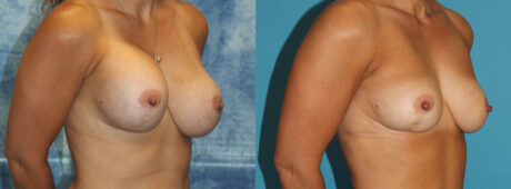 Fat Grafting to the Breast case #264627
