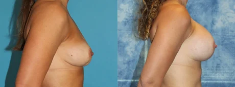 Fat Grafting to the Breast case #264627