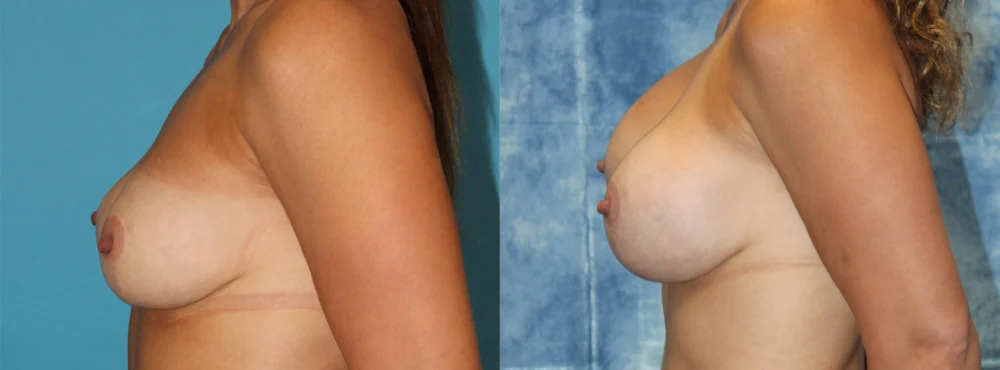 Fat Grafting to the Breast case #264627